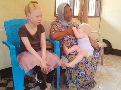 Young girl with albinism sits with her both, who does not have albinism. The mother is holding a baby who also albinism. 